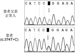 一种CRYBB1基因的SNP位点