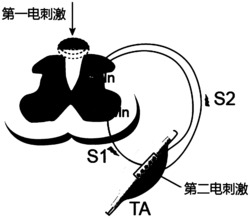 脊髓闭环性电刺激系统